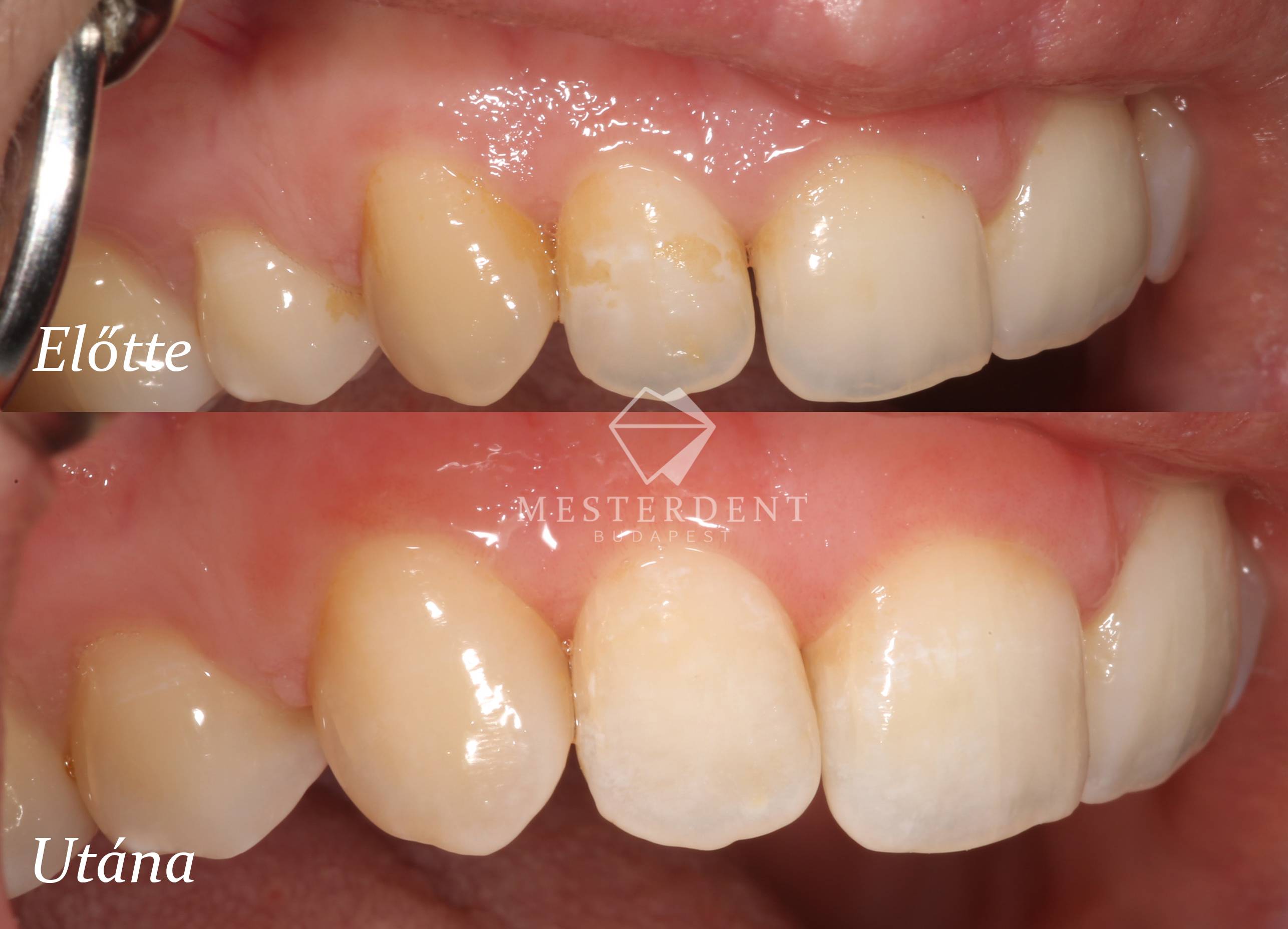 ICON kezelés előtt-után