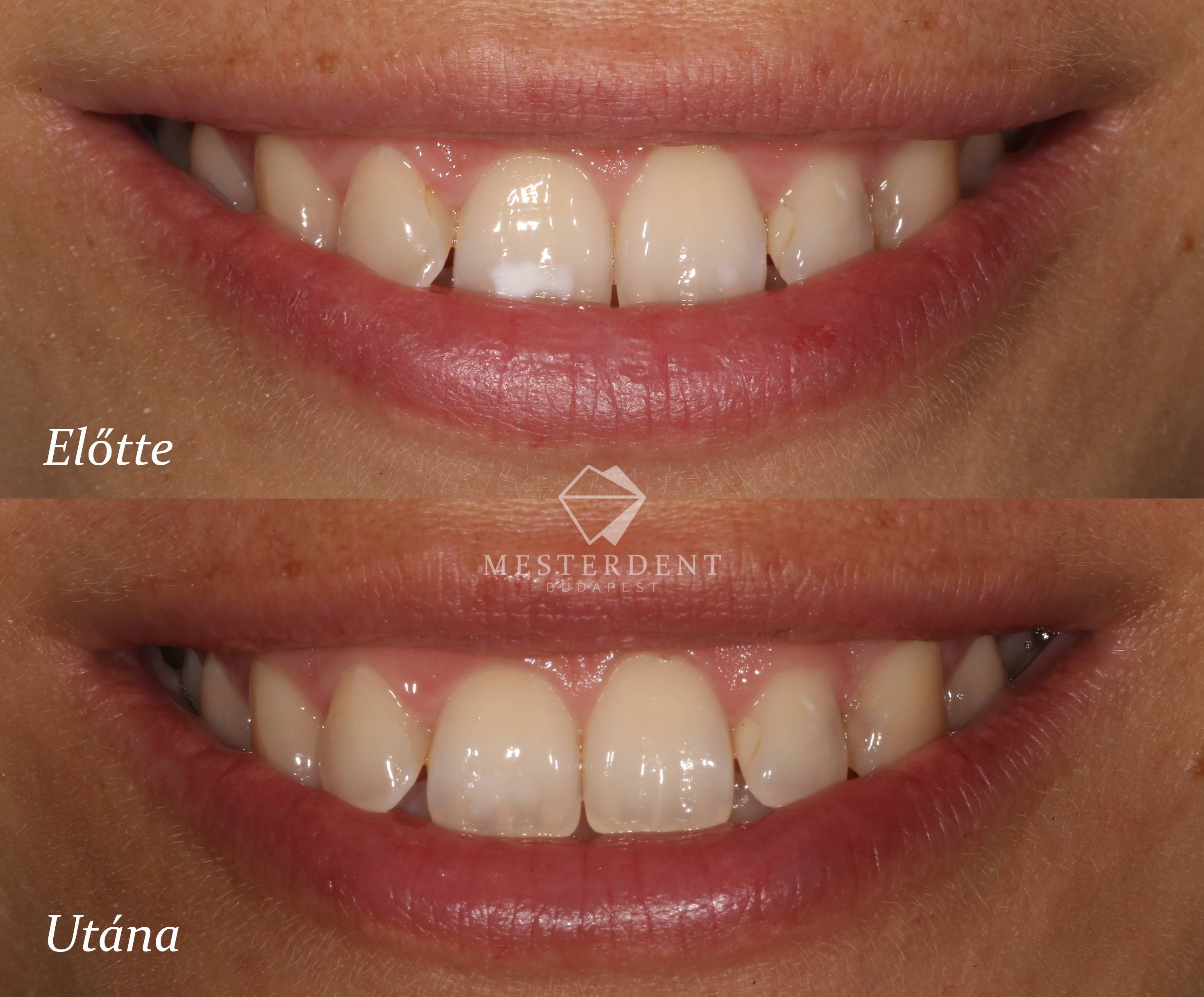 ICON kezelés előtt-után