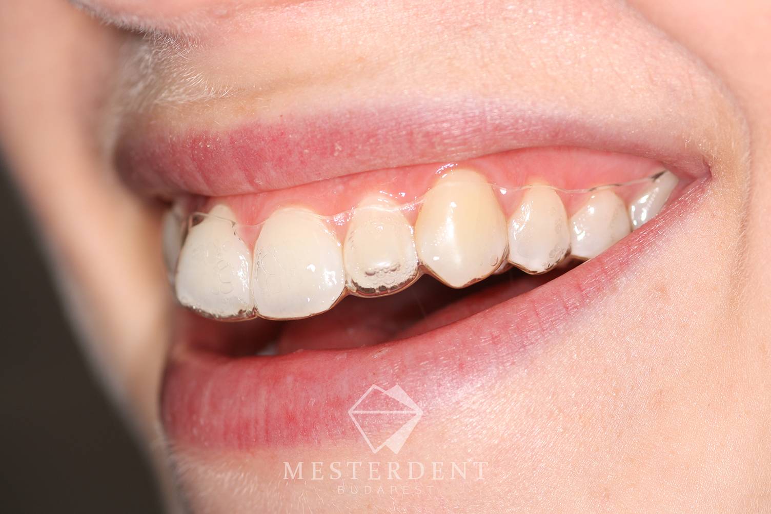 Láthatatlan sínes fogszabályozó a fogakon