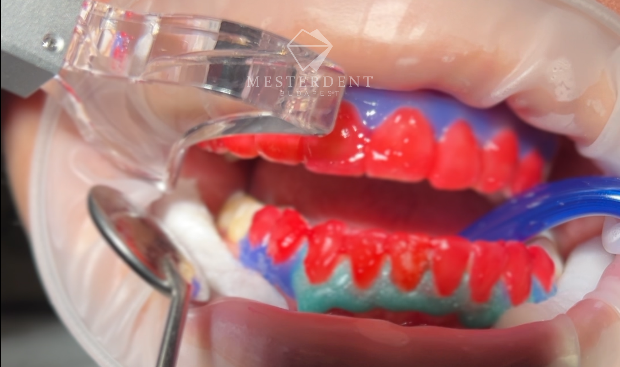 Lézeres fehérítés - fogfehérítő gél aktiválása lézerfénnyel