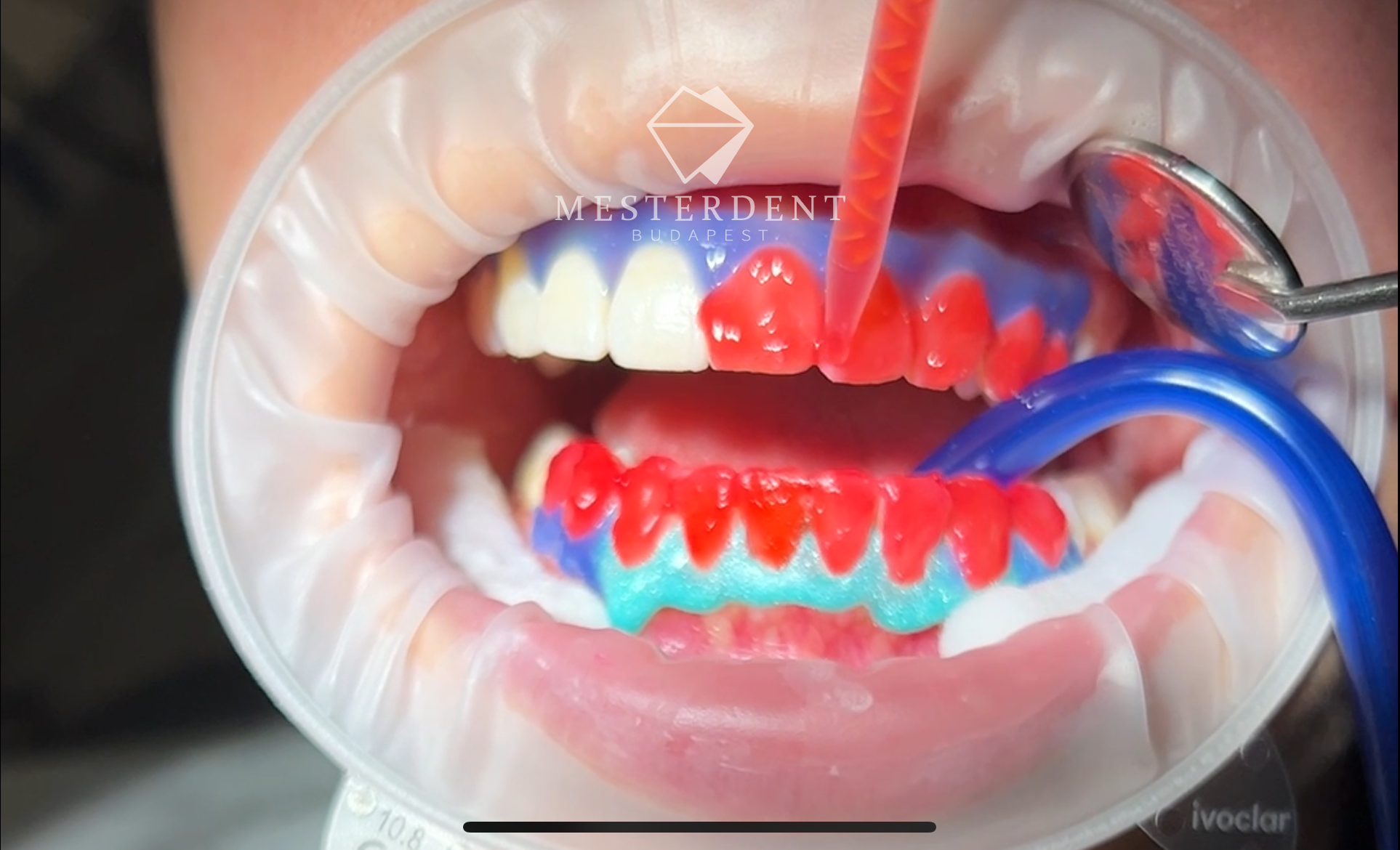 Lézeres fehérítés - fogfehérítő gél felkenése a fogakra