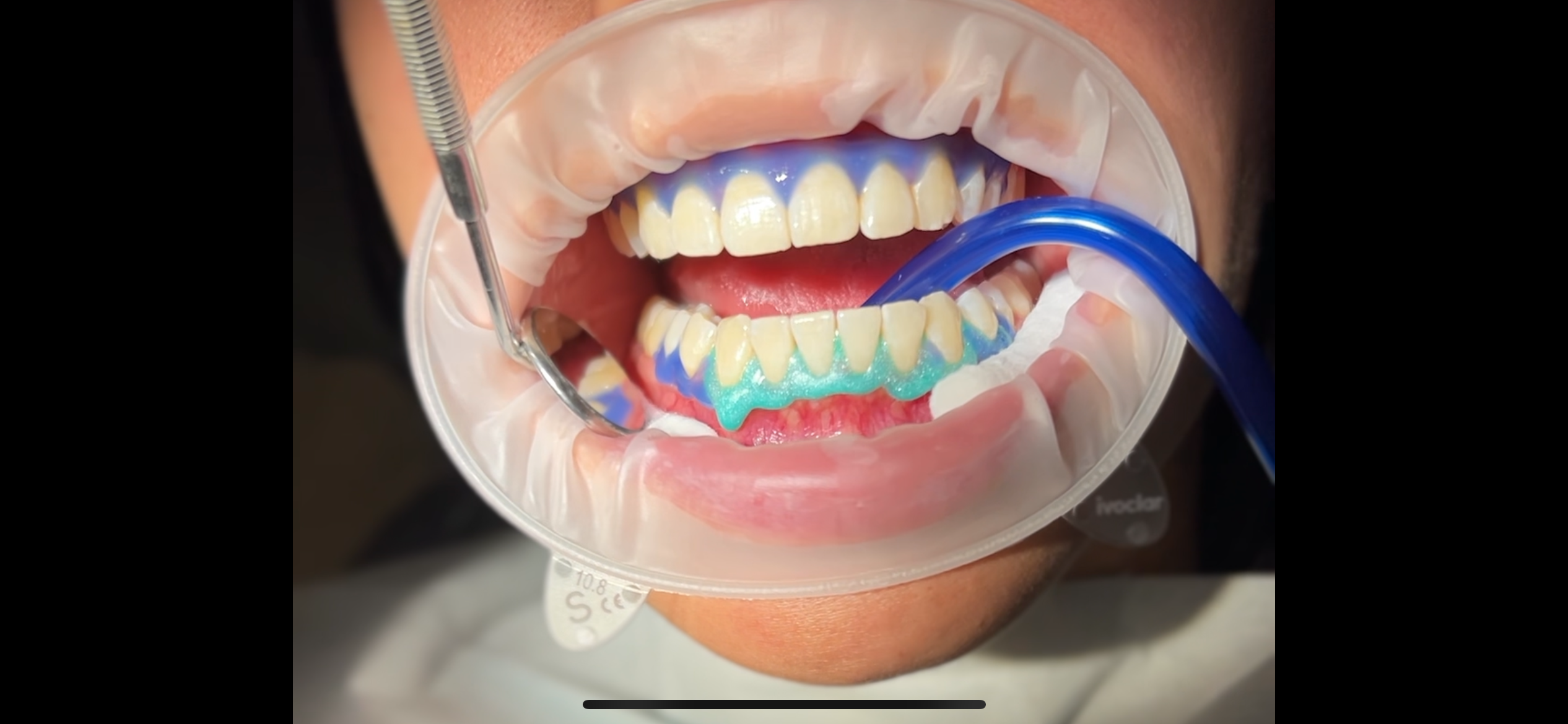 Lézeres fogfehérítés - ínyvédő alkalmazása